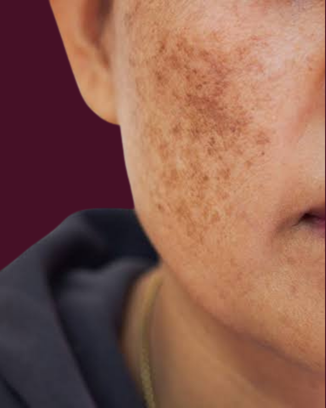 Hyperpigmentation