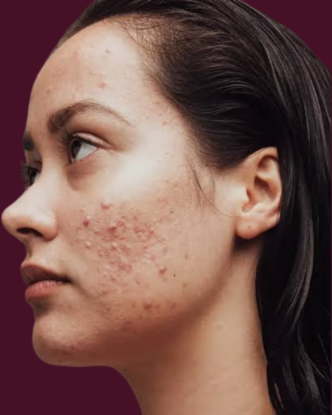 Acne
