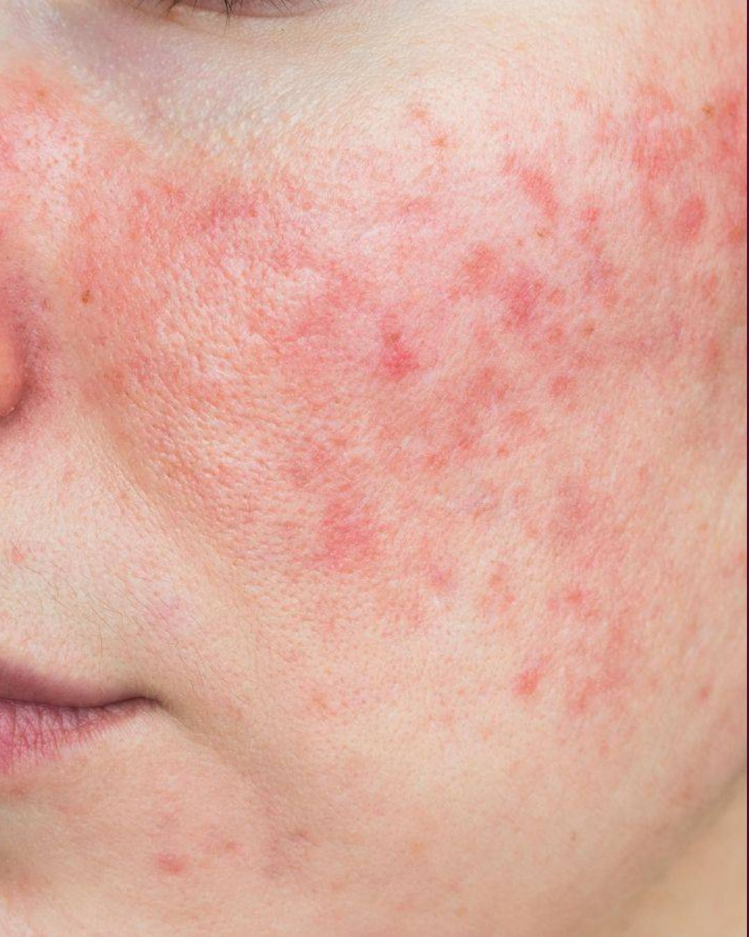 Rosacea